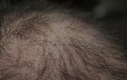 Efectividad tratamientos alopecia adrogenetica masculina