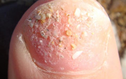 Différents types d'ongles