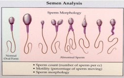 Sperm Deformities